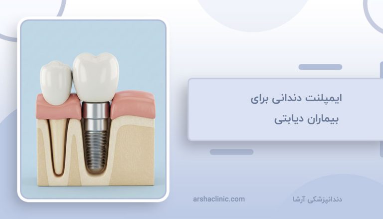 ایمپلنت دندان برای بیماران دیابتی