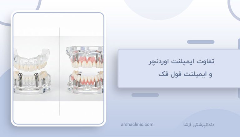 تفاوت ایمپلنت اوردنچر و ایمپلنت فول فک